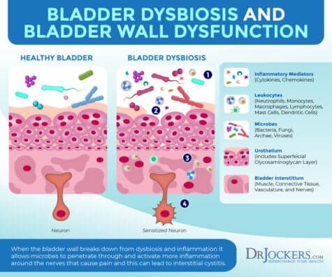 Interstitial Cystitis Symptoms Causes And Support Strategies