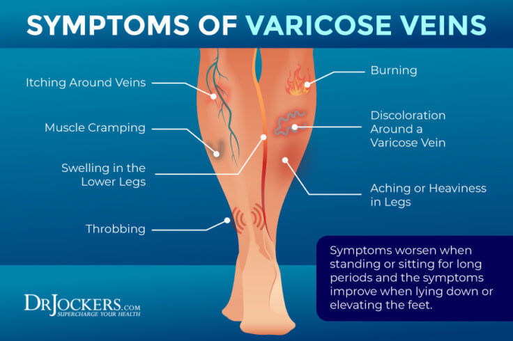 Varicose Veins Symptoms Causes And Natural Support Strategies