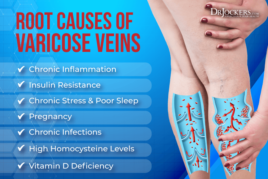 varicose veins, Varicose Veins: Symptoms, Causes, and Natural Support Strategies