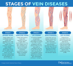 Varicose Veins: Symptoms, Causes and Natural Support Strategies