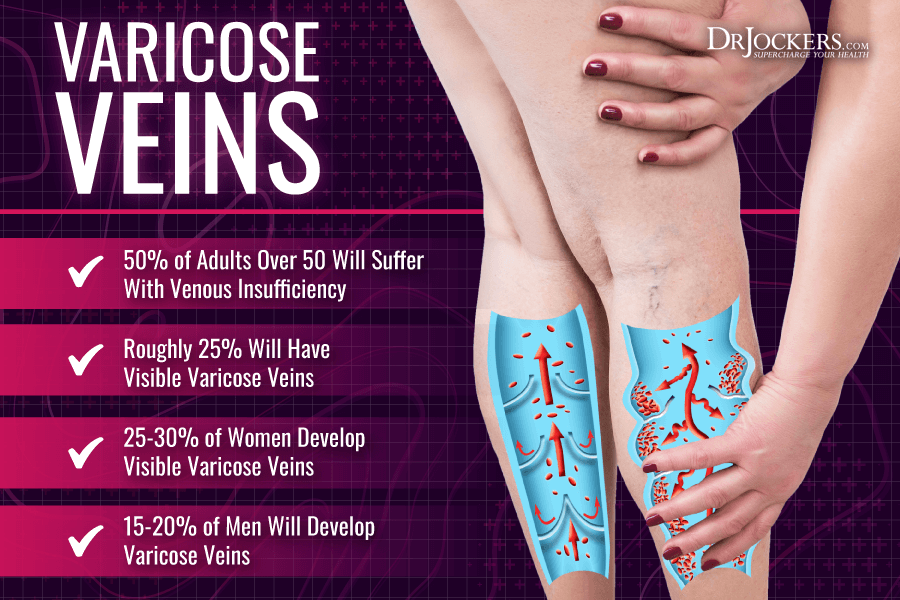 varicose veins, Varicose Veins: Symptoms, Causes, and Natural Support Strategies