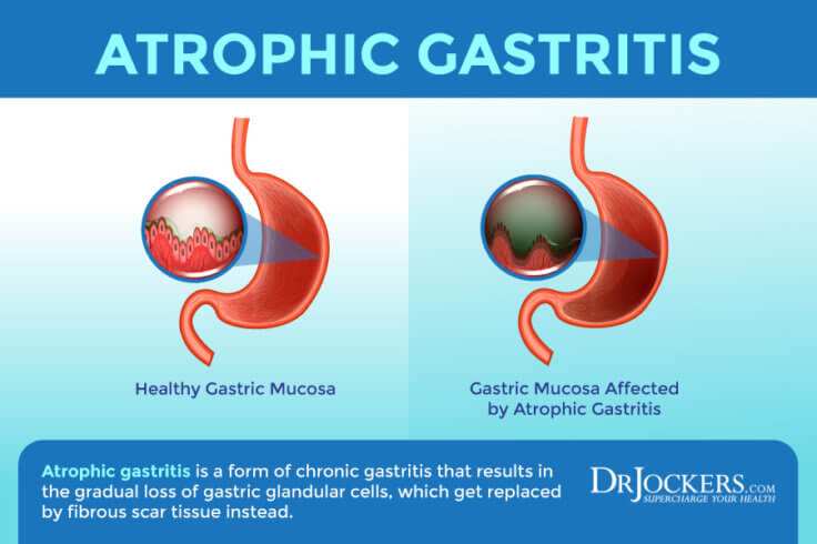 Gastritis: Symptoms, Causes, and Support Strategies - DrJockers.com