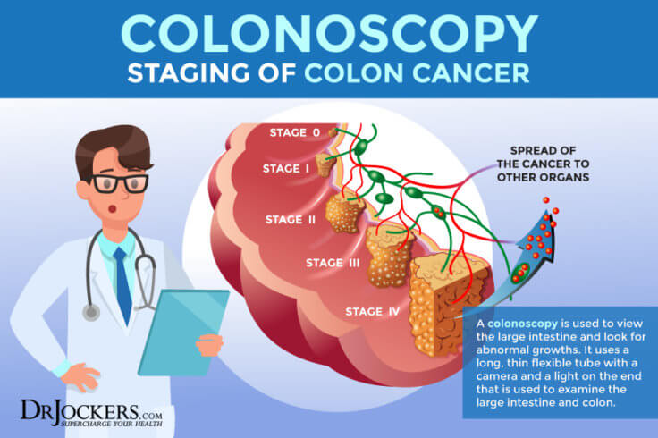 Colon Cancer: Symptoms, Causes and Support Strategies