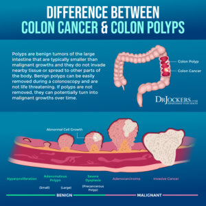 Colon Cancer: Symptoms, Causes and Support Strategies