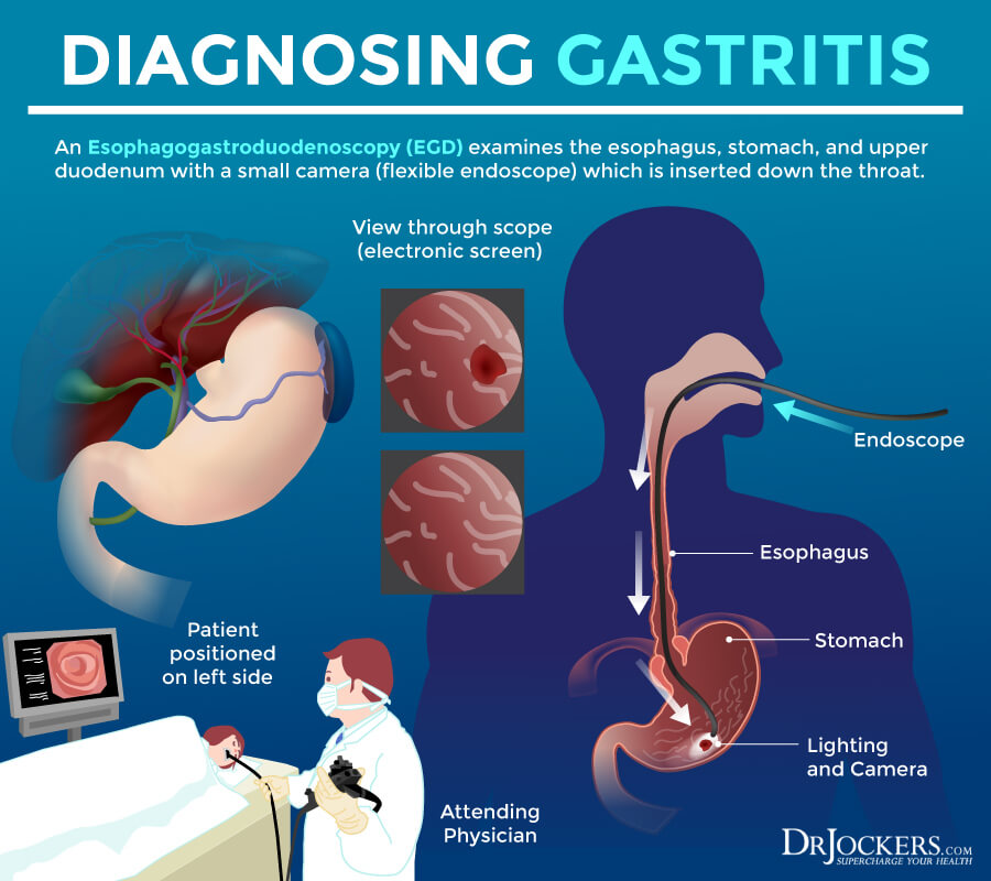 gastritis, Gastritis: Symptoms, Causes, and Support Strategies