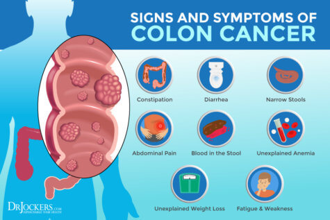 Colon Cancer: Symptoms, Causes and Support Strategies