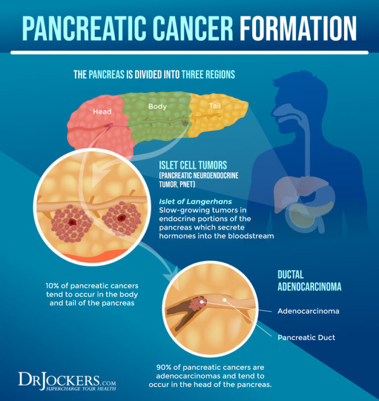 Pancreatic Cancer: Symptoms, Causes And Support Strategies