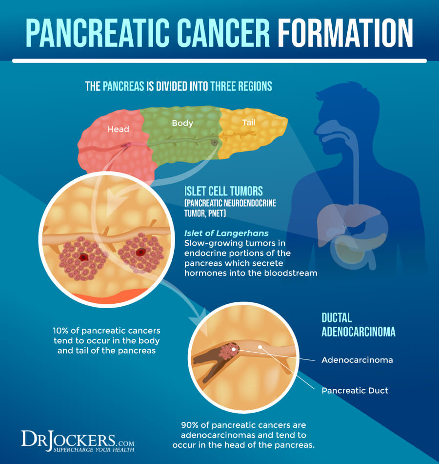 Pancreatic cancer, Pancreatic Cancer: Symptoms, Causes, and Support Strategies