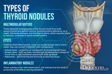 Thyroid Nodules: Symptoms, Causes, and Support Strategies