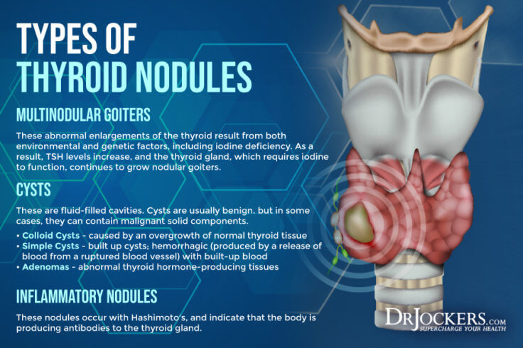 Thyroid Nodules Symptoms Causes And Support Strategies