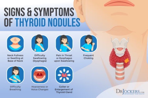 Thyroid Nodules: Symptoms, Causes, and Support Strategies
