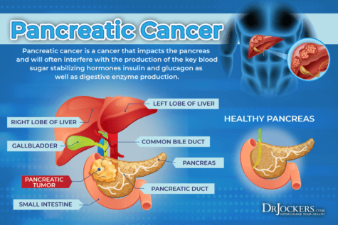 Pancreatic Cancer: Symptoms, Causes and Support Strategies