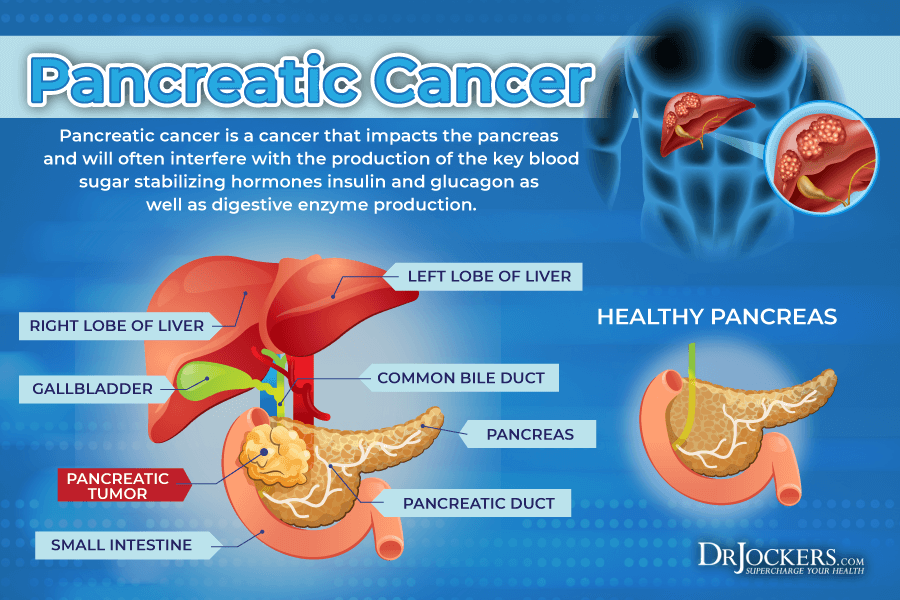Pancreatic cancer, Pancreatic Cancer: Symptoms, Causes, and Support Strategies