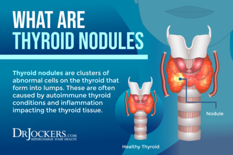 Thyroid Nodules: Symptoms, Causes, And Support Strategies