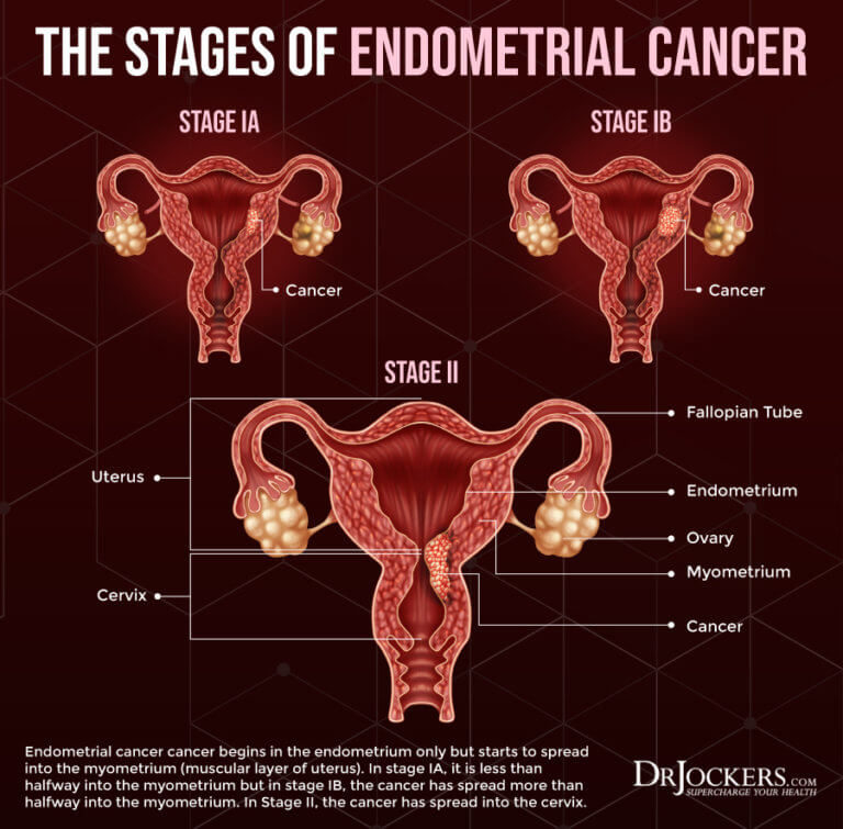 Endometrial Cancer Symptoms Causes And Support Strategies