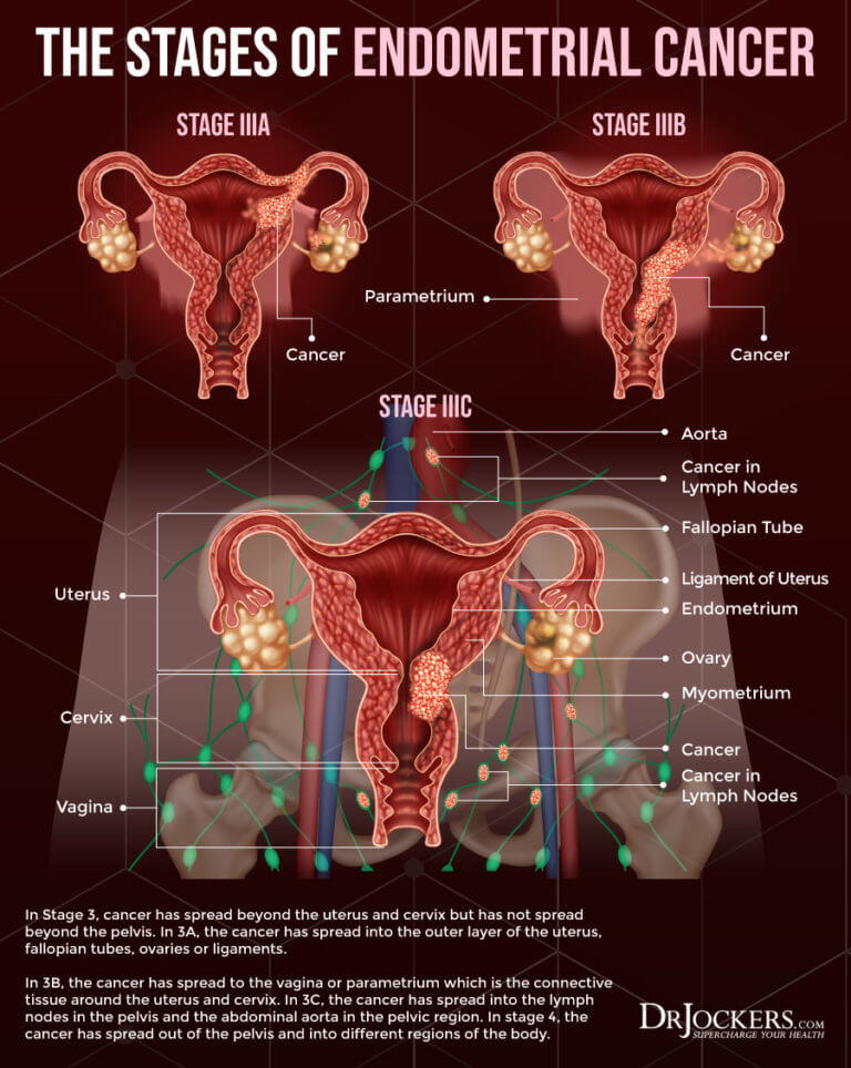 medical-info-figo-staging-cervical-ca-ovarian-ca-endometrial-ca