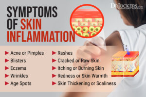 Skin Rashes: Symptoms, Causes and Natural Support Strategies