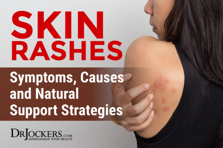 Skin Rashes: Symptoms, Causes and Natural Support Strategies