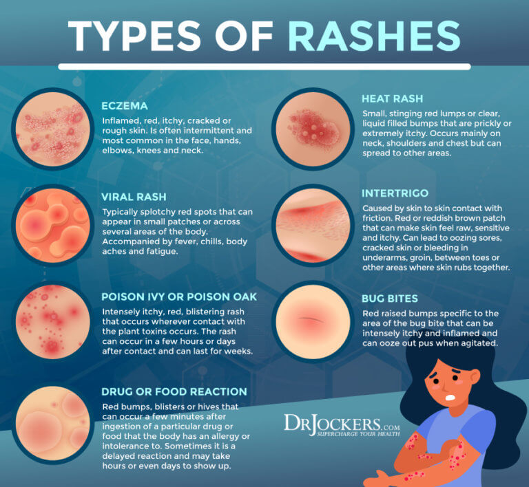 Skin Rashes: Symptoms, Causes and Natural Support Strategies