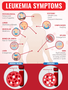 Leukemia: Symptoms, Causes, and Support Strategies - DrJockers.com