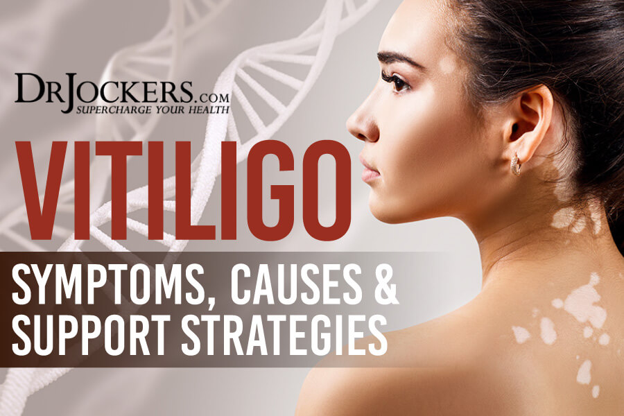 vitiligo, Vitiligo: Symptoms, Causes, and Support Strategies