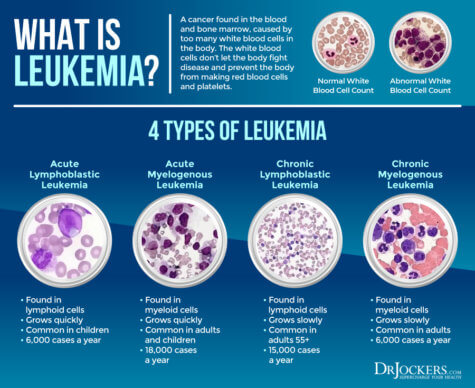 Leukemia: Symptoms, Causes, and Support Strategies - DrJockers.com