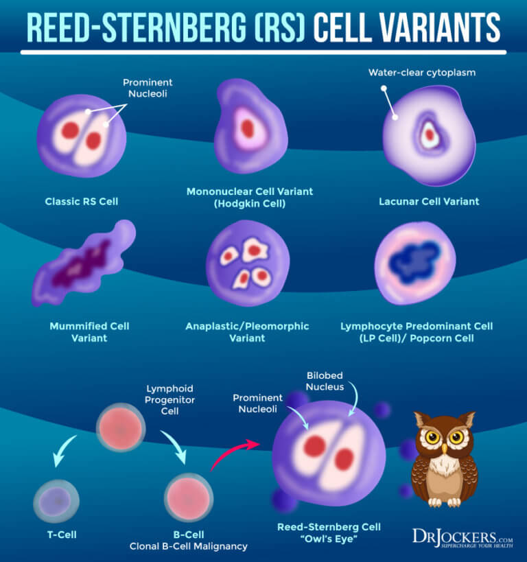 Lymphoma Symptoms, Causes, and Support Strategies