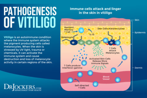 Vitiligo: Symptoms, Causes, And Support Strategies