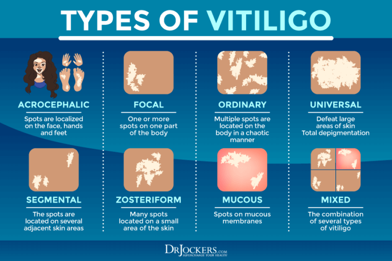 Vitiligo symptoms causes and support strategies
