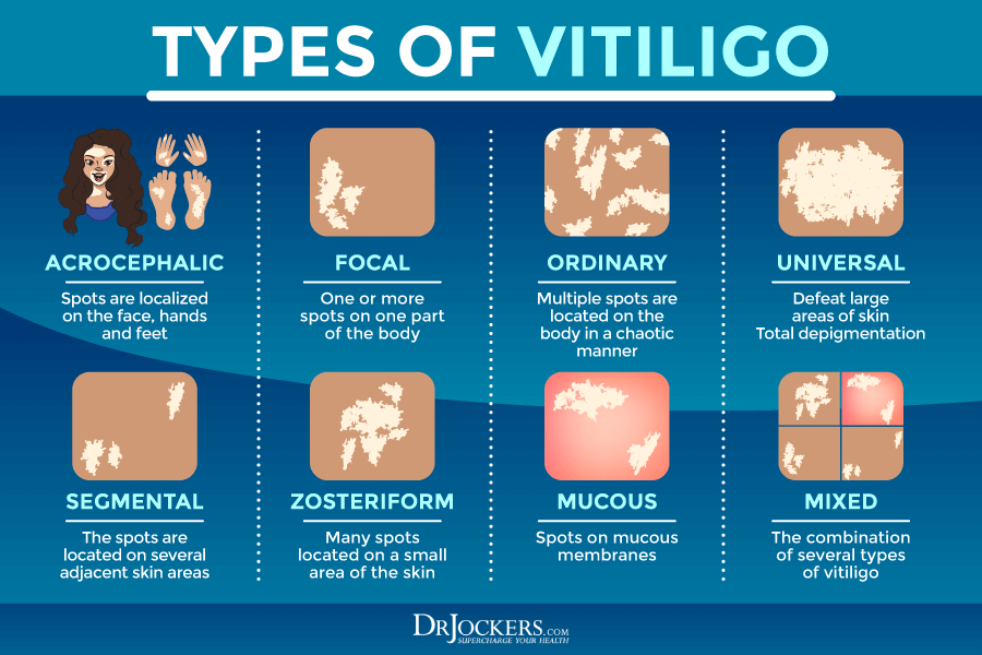 vitiligo, Vitiligo: Symptoms, Causes, and Support Strategies