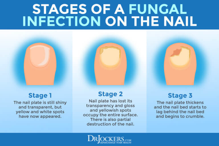 Toenail Fungus: Symptoms, Causes and Support Strategies