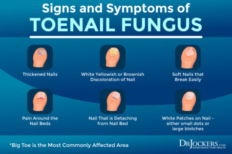 Toenail Fungus: Symptoms, Causes and Support Strategies