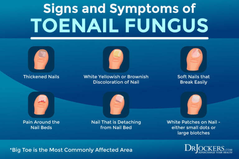 Toenail Fungus: Symptoms, Causes And Support Strategies