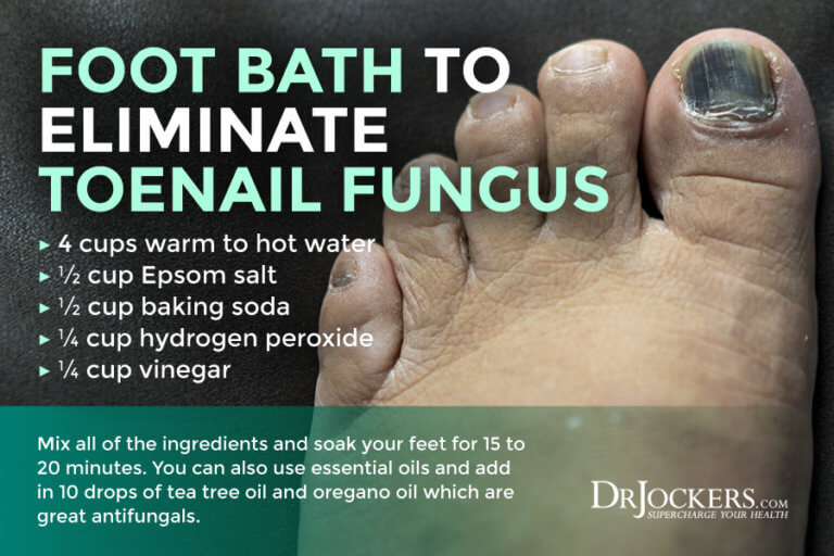 Toenail Fungus Symptoms, Causes and Support Strategies