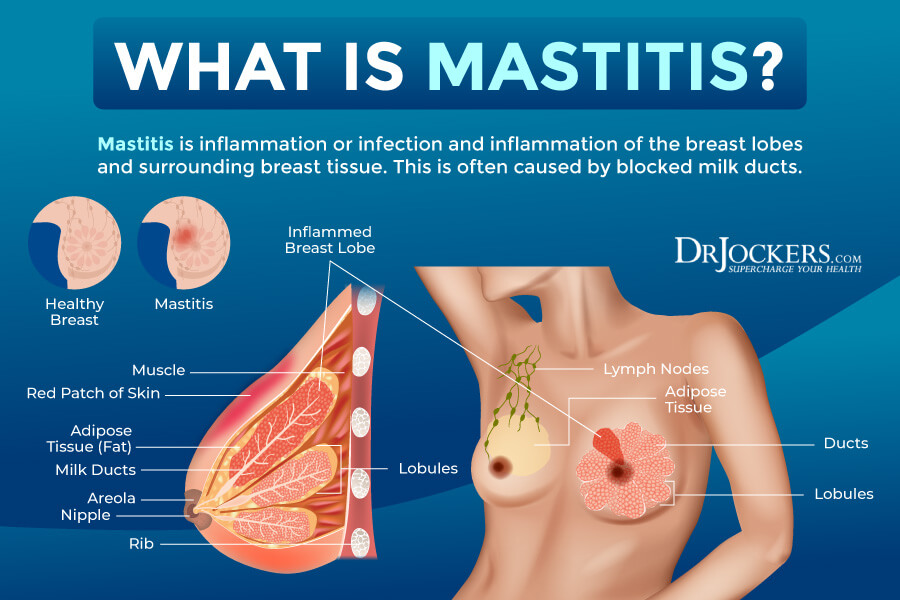 Mastitis (Breasts Infection) – Reasons, Signs & Remedies
