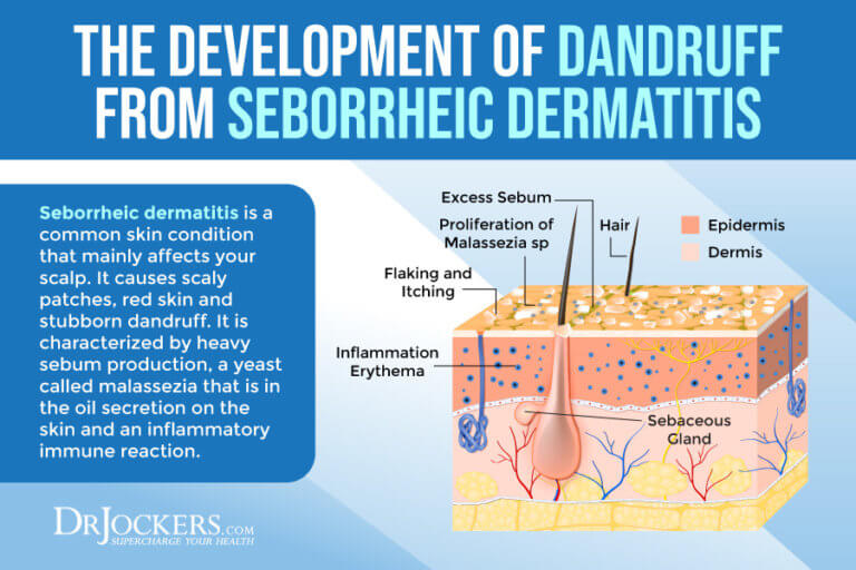 Dandruff: Root Causes and Support Strategies - DrJockers.com