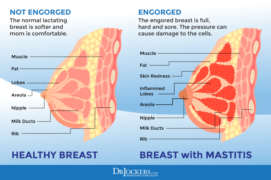 Mastitis and breast engorgement are painful. Wearing right support bras may  ease your journey.