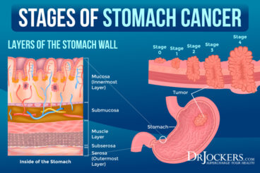 Stomach Cancer: Symptoms, Causes, and Support Strategies