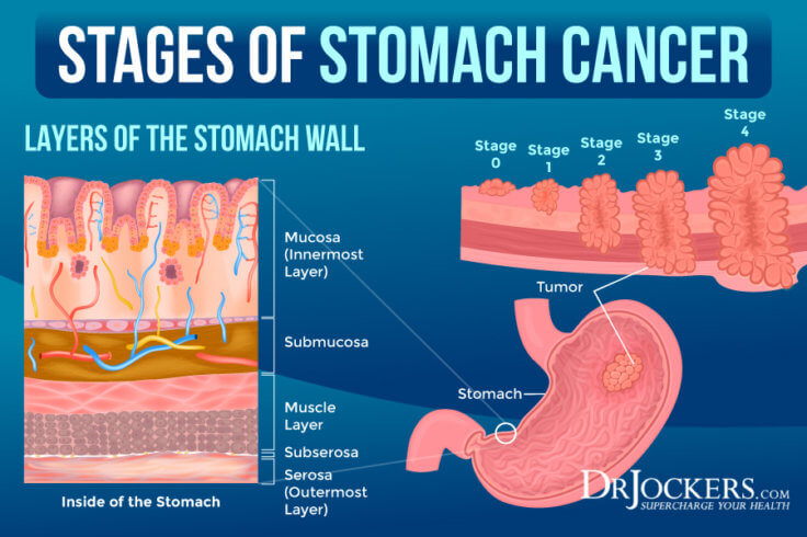 Stomach Cancer: Symptoms, Causes, and Support Strategies