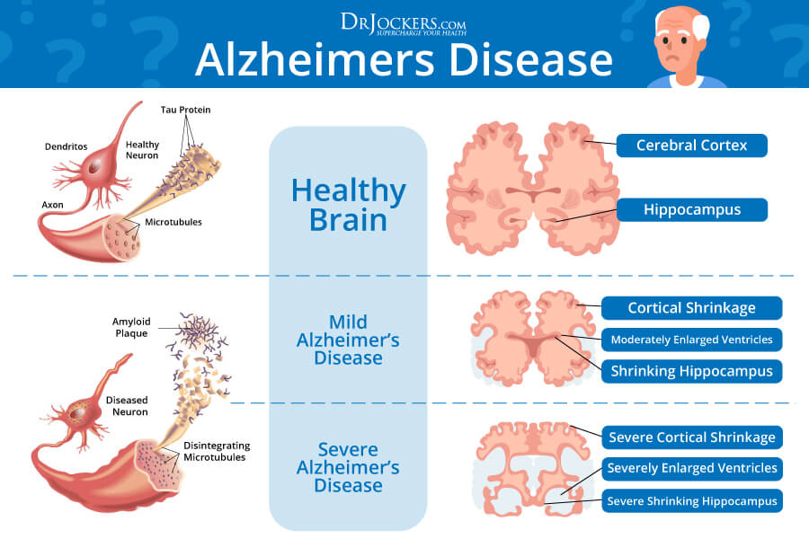 Alzheimer's Disease, Alzheimer&#8217;s Disease: Symptoms, Causes and Natural Support Strategies