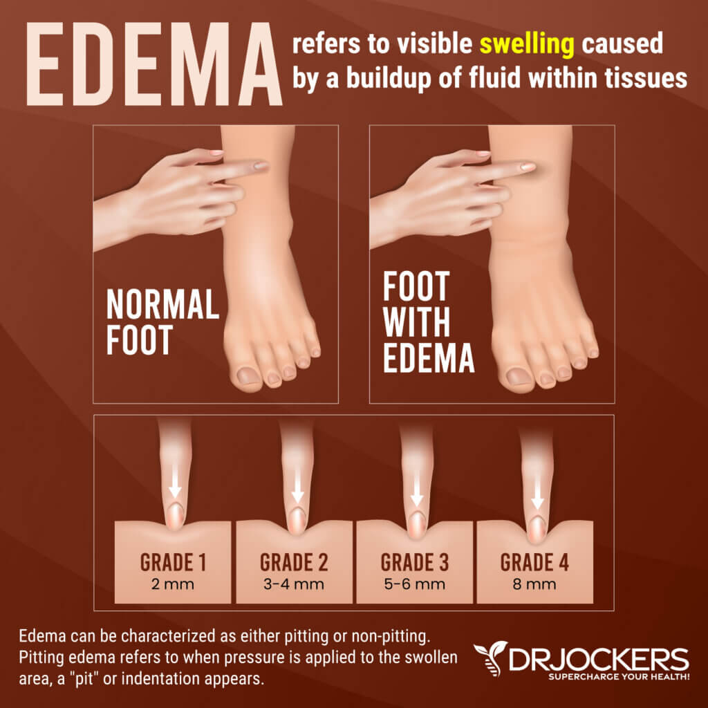 Edema: Symptoms, Causes, and Natural Support Strategies