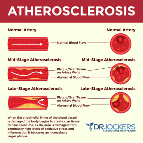 Clogged Arteries: Causes, Symptoms & Support Strategies